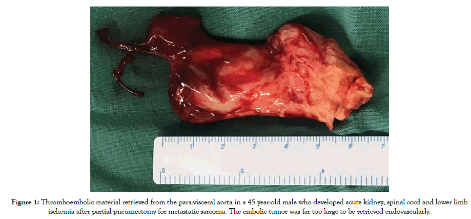 vascular-medicine-surgery-Thromboembolic material